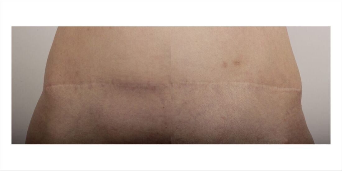 Scar